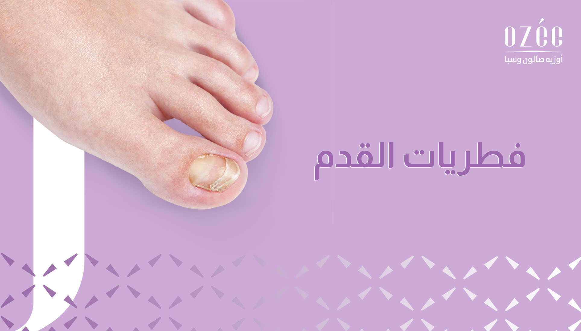 دليل شامل للتخلص من فطريات أظافر القدم: الأسباب والأعراض وطرق العلاج