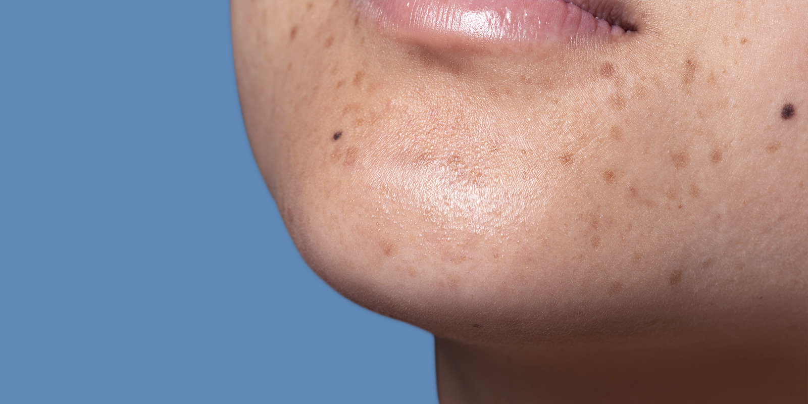 Dark Spots: Understanding the Causes, Treatment, and Prevention