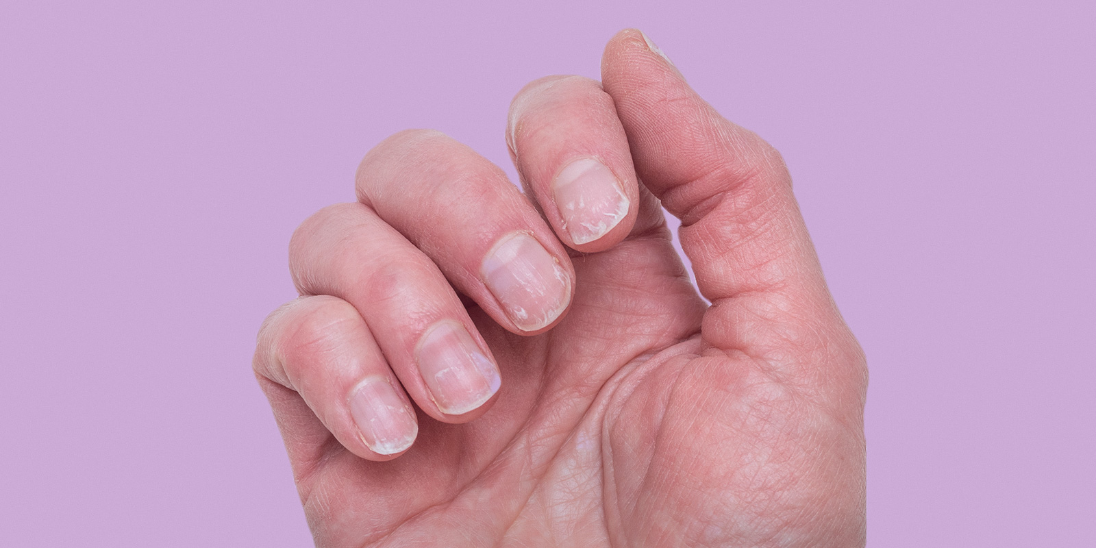 Brittle Nails: Causes and Ways to Prevent This Common Problem